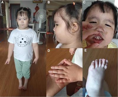 Helsmoortel–van der Aa syndrome in a Chinese pediatric patient due to ADNP nonsense mutation: A case report